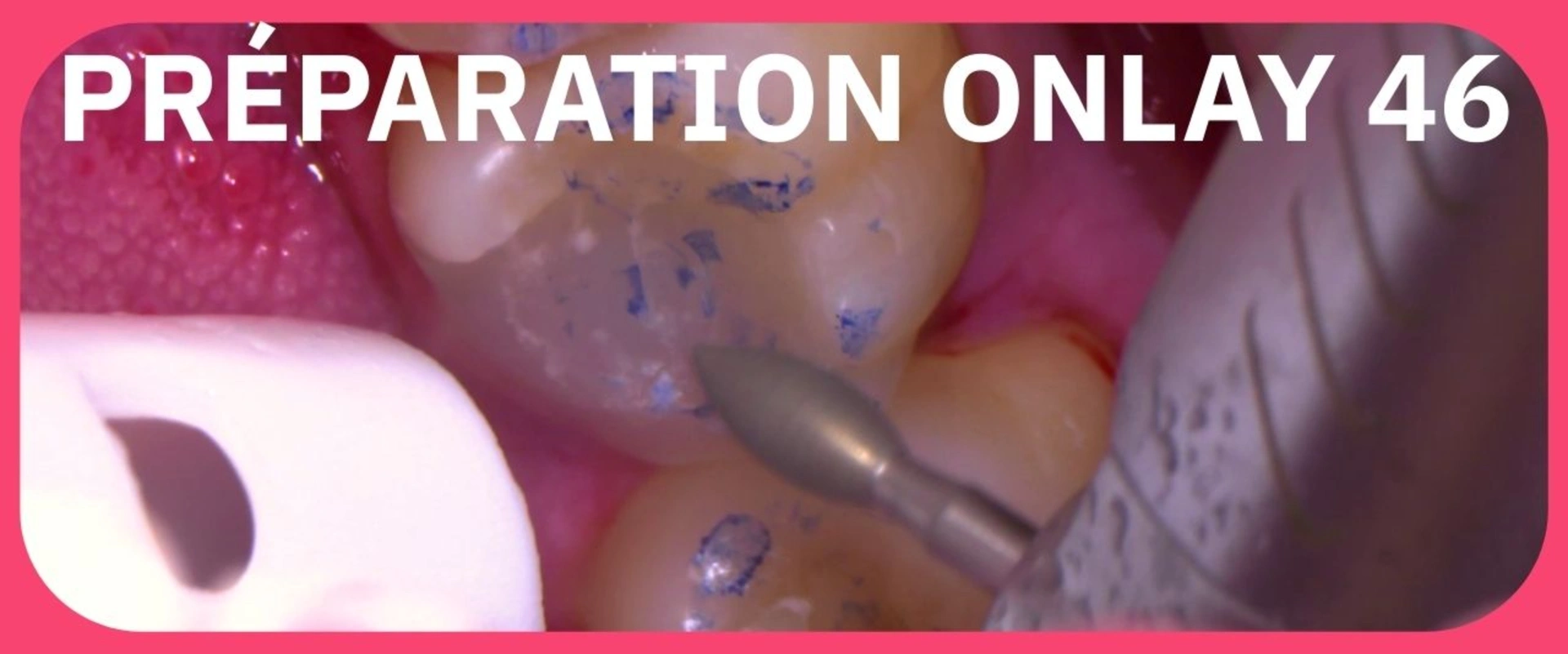 Academie du sourire : Onlay 46 Préparation