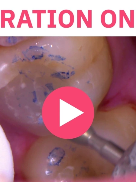 Academie du sourire : Onlay 46 Préparation