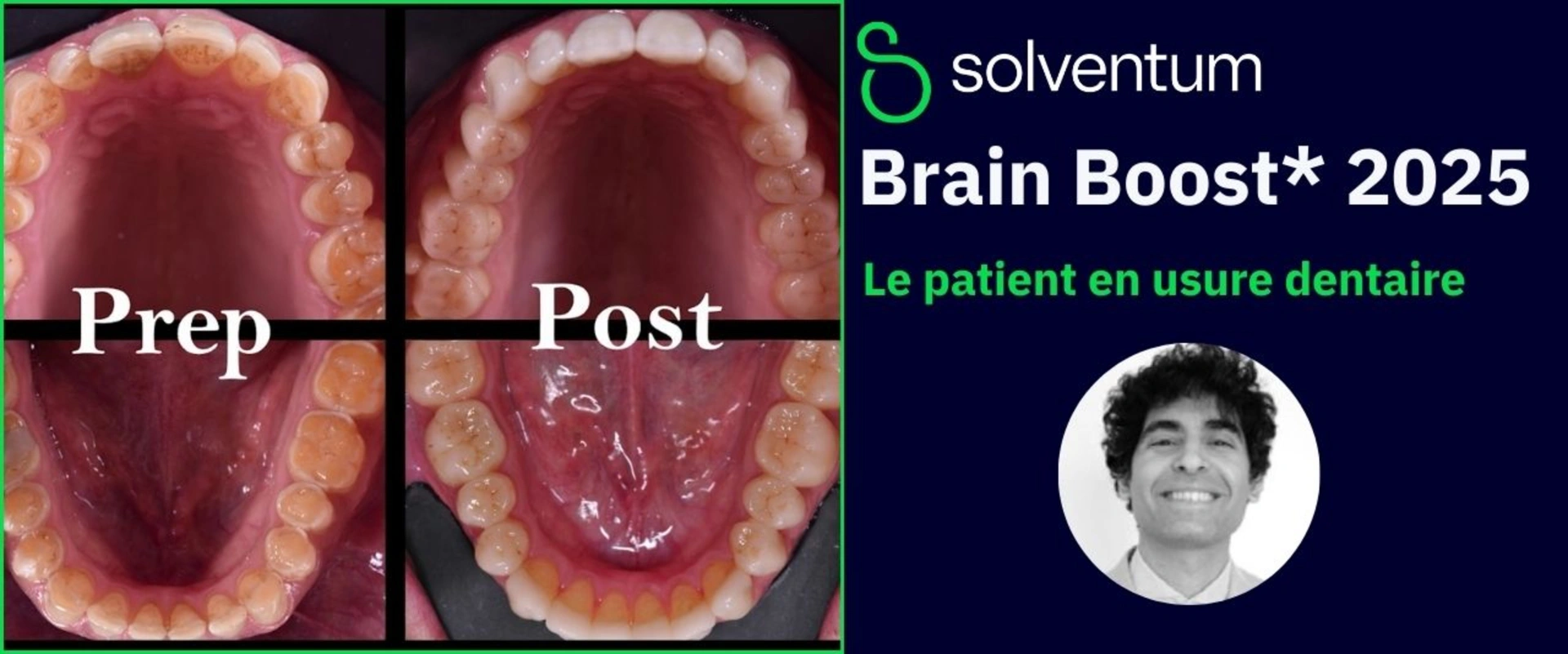 Brain Boost 2025 : Le patient en usure dentaire