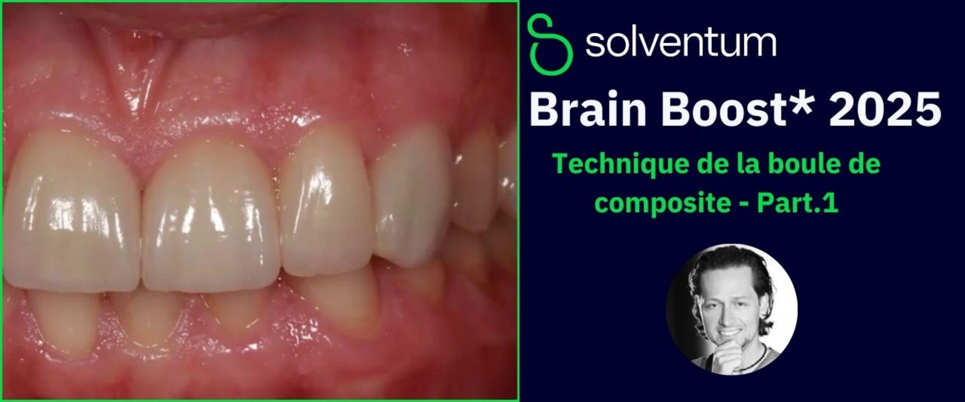 Brain Boost 2025 : Augmentation de la dimension verticale avec les composites directs - Part1