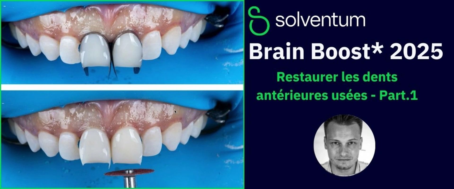 Brain Boost 2025 : Restaurer les dents antérieures usées - Part1