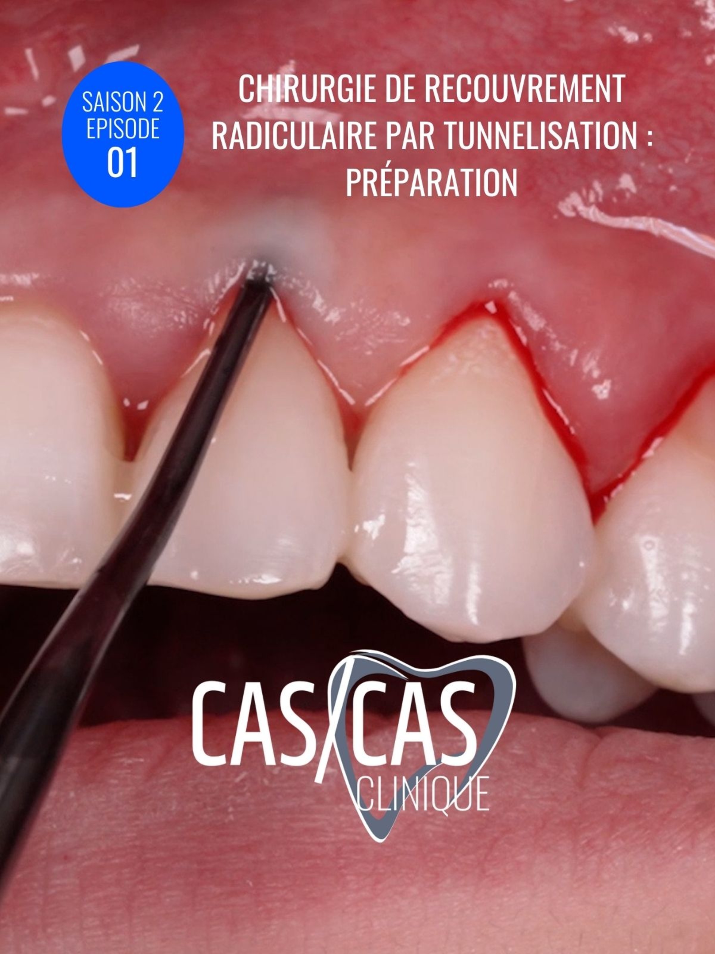 Chirurgie de recouvrement radiculaire par tunnelisation : Préparation