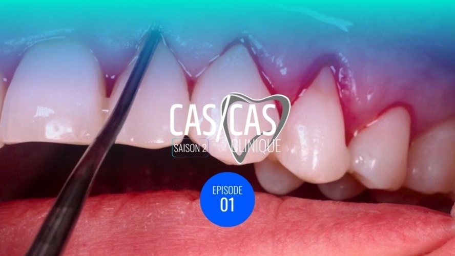 Chirurgie de recouvrement radiculaire par tunnelisation : Préparation