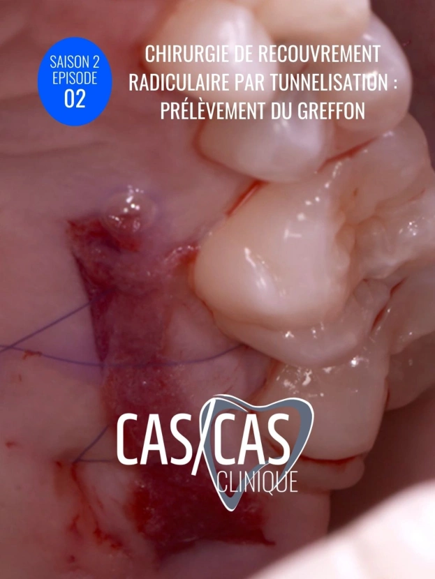 Chirurgie de recouvrement radiculaire par tunnelisation : Prélèvement du greffon