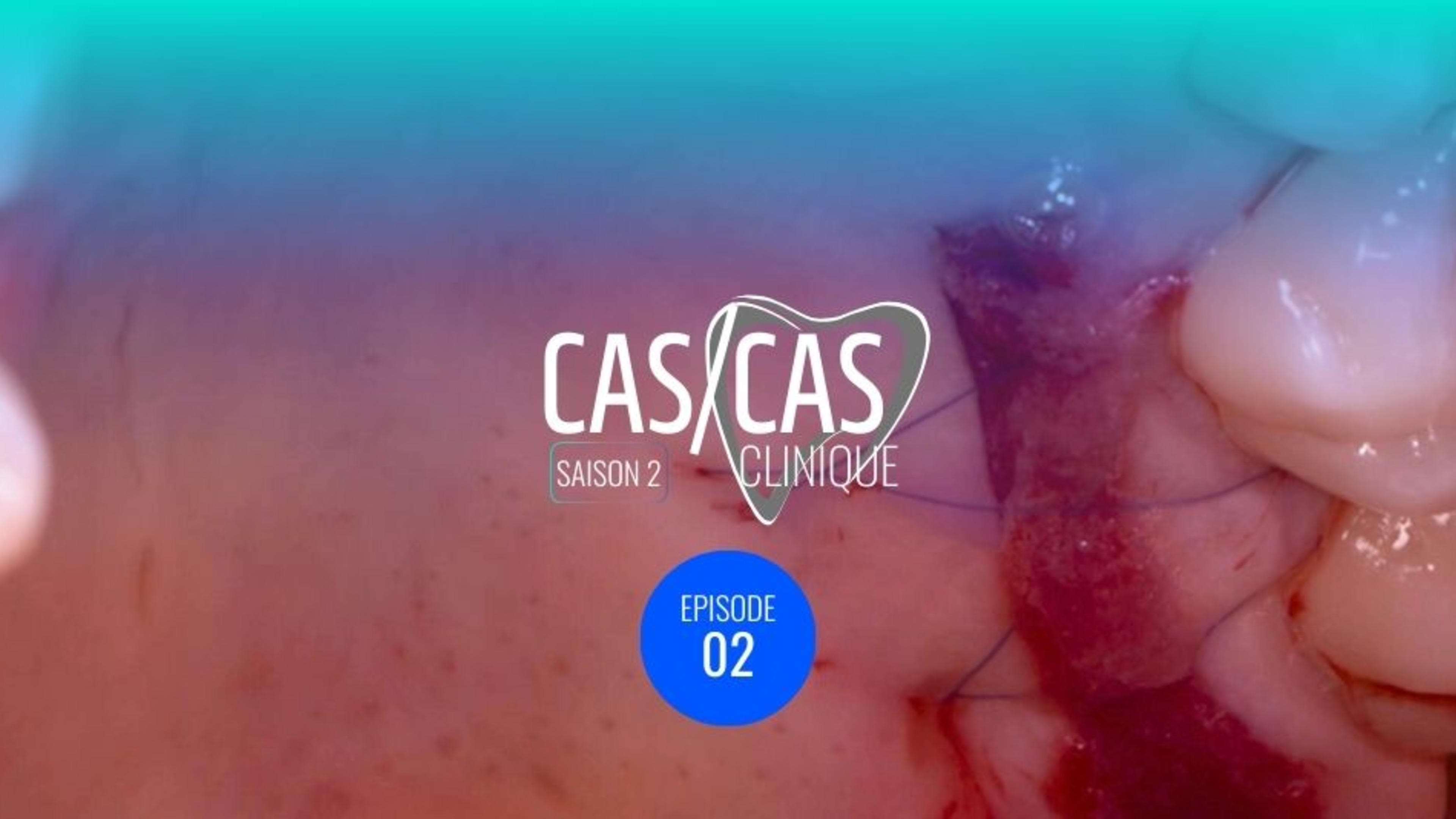 Chirurgie de recouvrement radiculaire par tunnelisation : Prélèvement du greffon