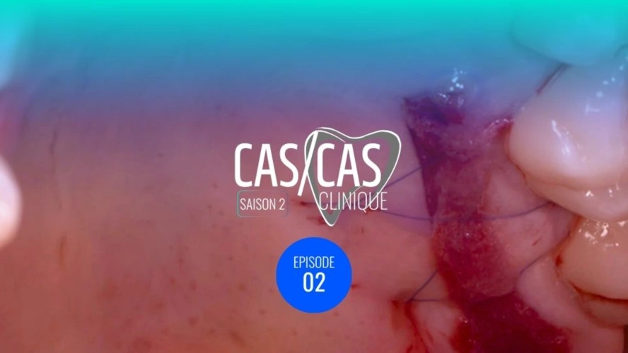 Chirurgie de recouvrement radiculaire par tunnelisation : Prélèvement du greffon