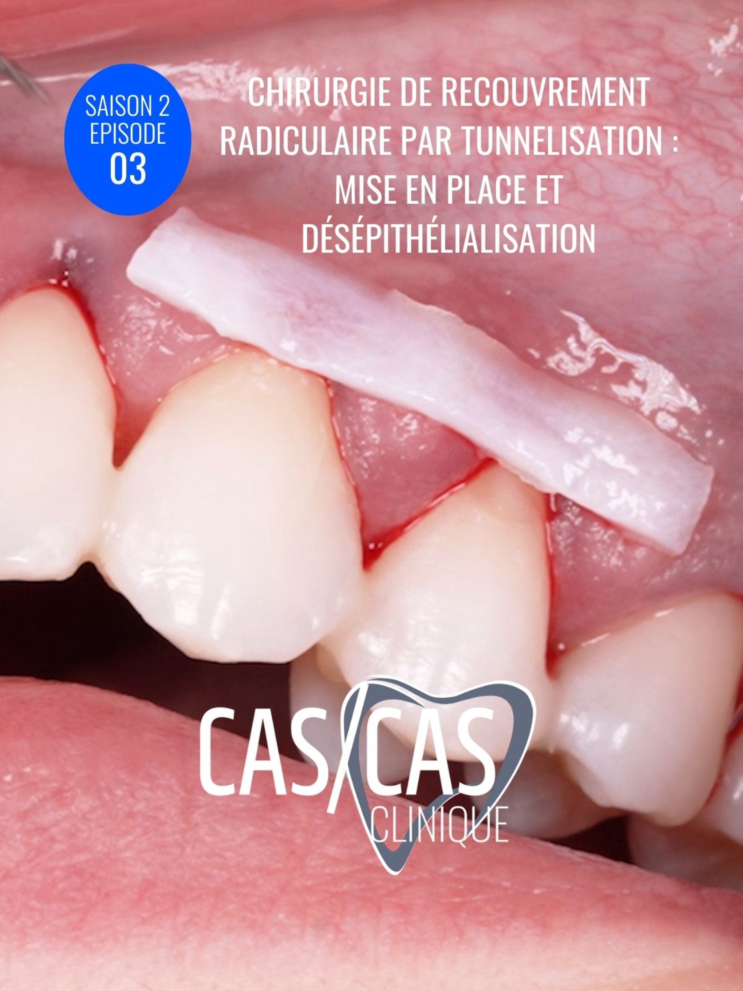 Chirurgie de recouvrement radiculaire par tunnelisation : Mise en place et désépithélialisation