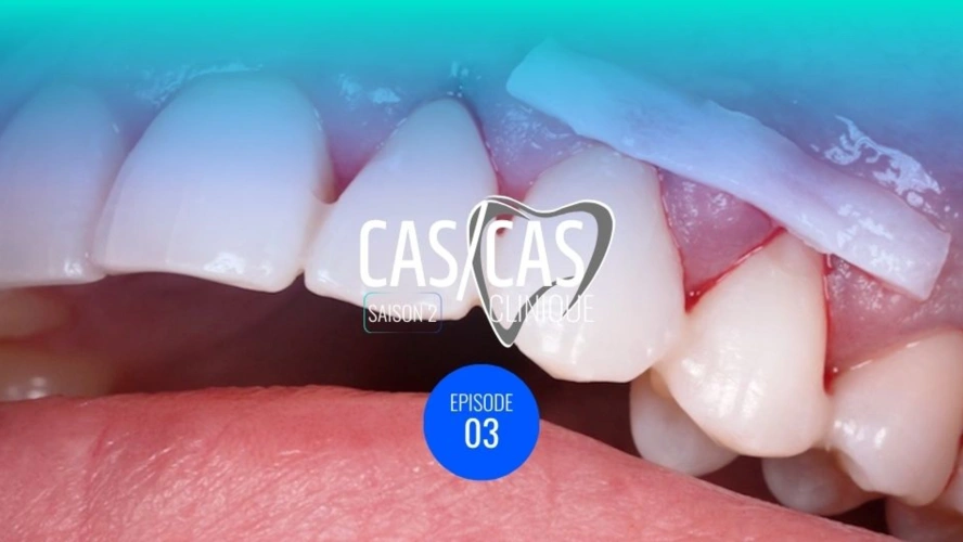 Chirurgie de recouvrement radiculaire par tunnelisation : Mise en place et désépithélialisation