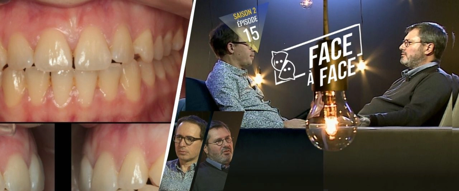 Orthodontie : la canine incluse maxillaire, critères de prise en charge