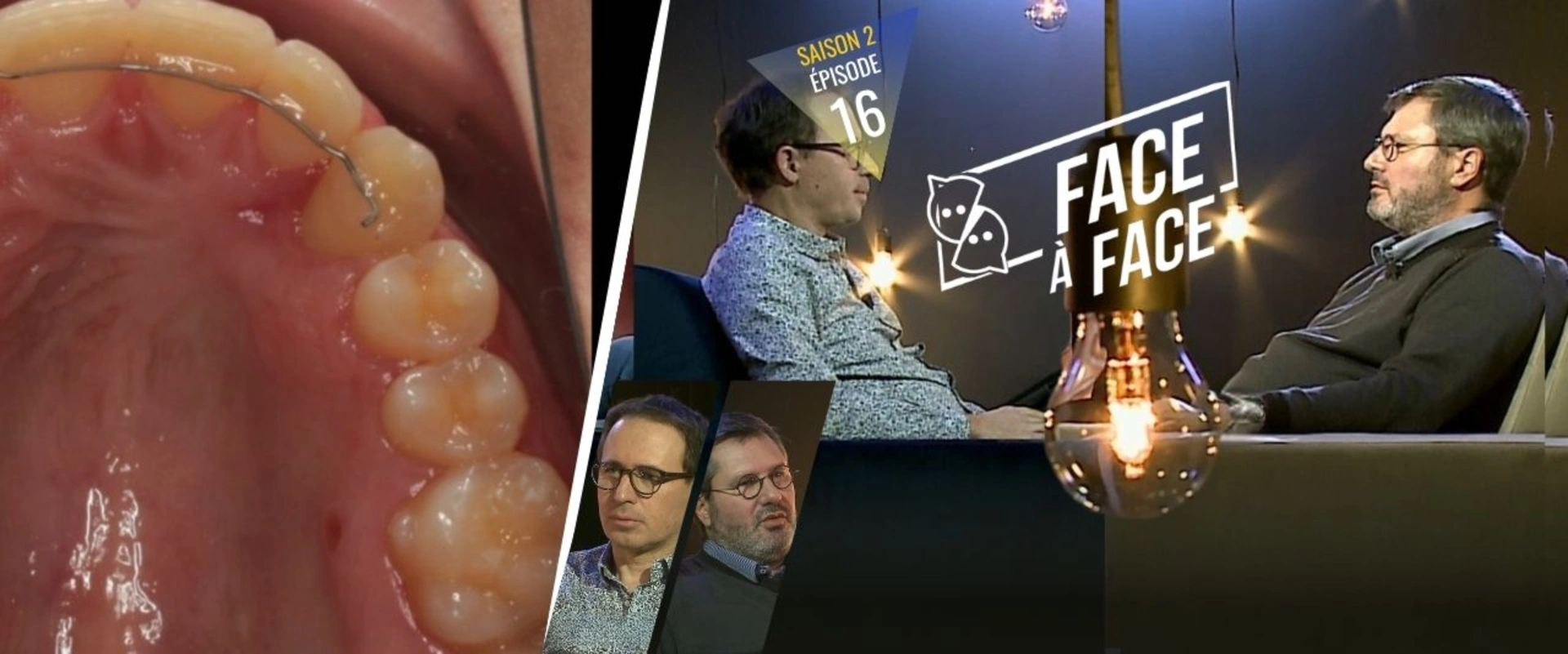 Orthodontie : La canine incluse maxillaire, parodonte et zones de dégagement