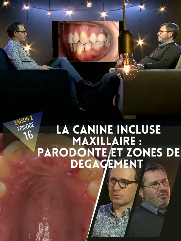 Orthodontie : La canine incluse maxillaire, parodonte et zones de dégagement