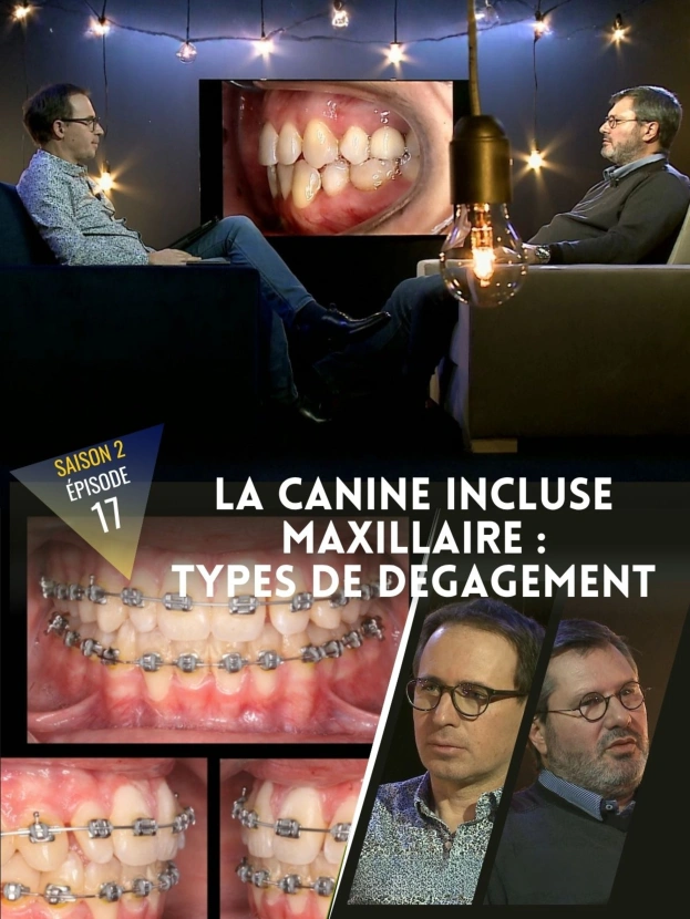 Orthodontie : La canine incluse maxillaire, types de dégagement