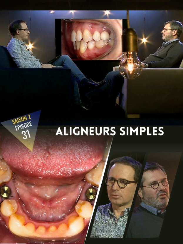 Aligneurs : Cas simple