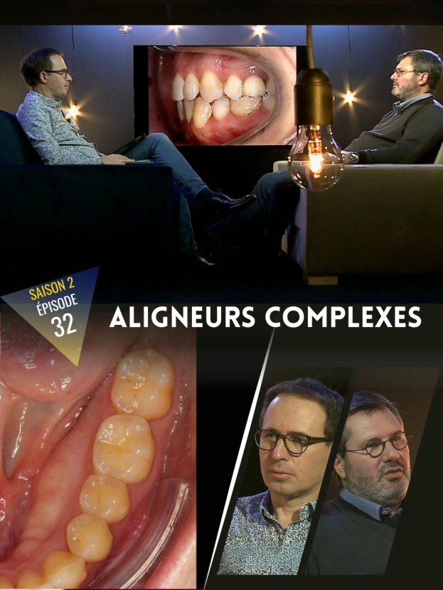 Aligneurs : Cas complexe Classe II
