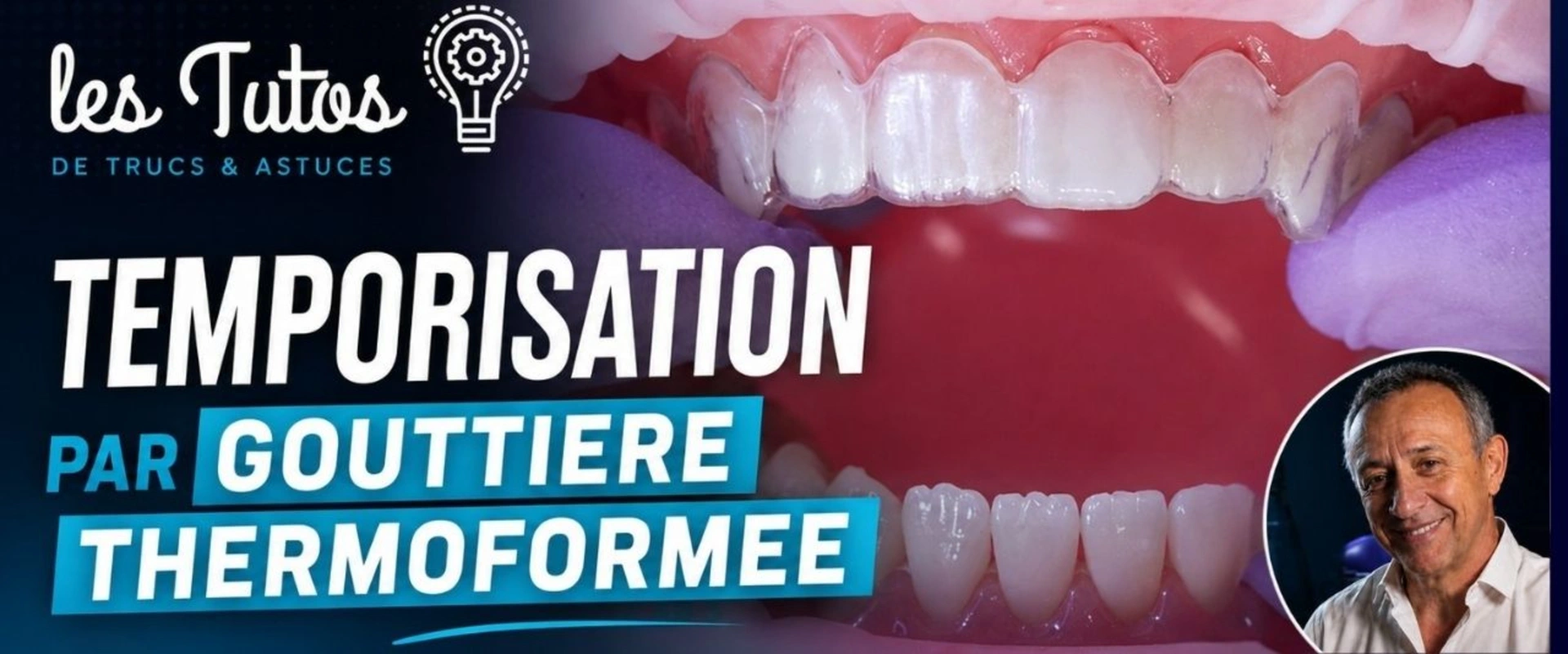 Temporisation par gouttière thermoformée