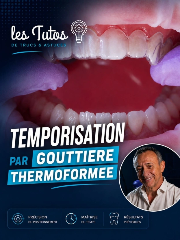 Temporisation par gouttière thermoformée