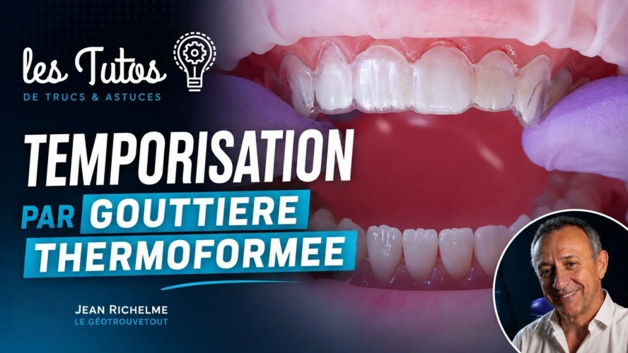 Temporisation par gouttière thermoformée