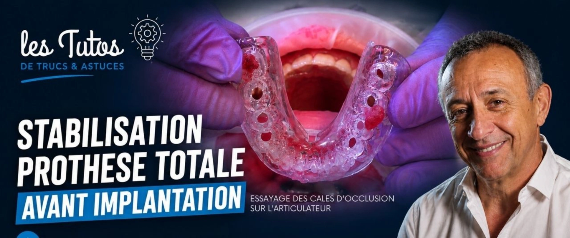 Stabilisation prothèse totale avant implantation