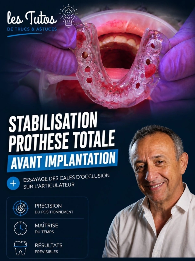 Stabilisation prothèse totale avant implantation