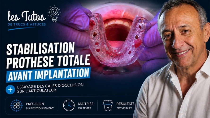 Stabilisation prothèse totale avant implantation