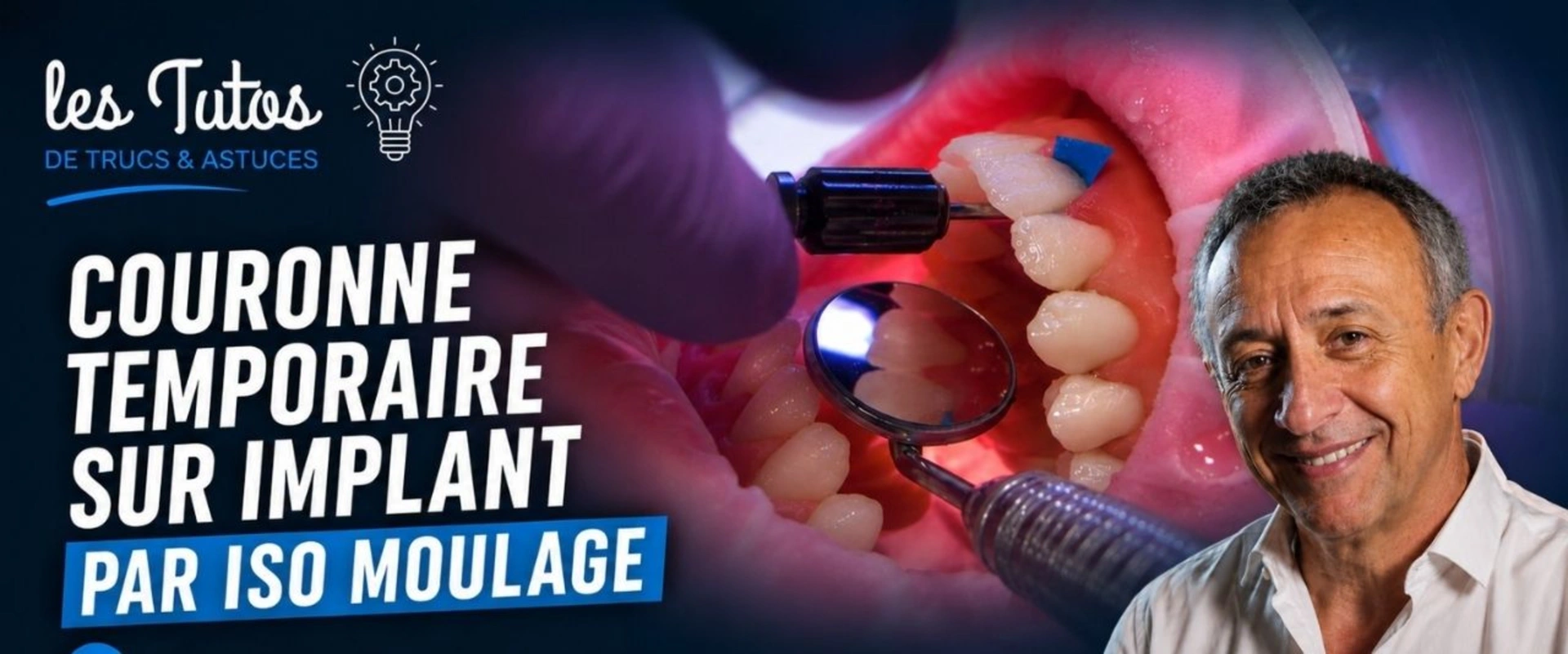 Couronne temporaire sur implant par iso moulage