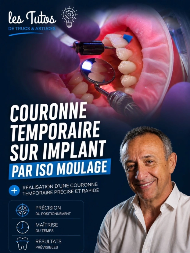 Couronne temporaire sur implant par iso moulage
