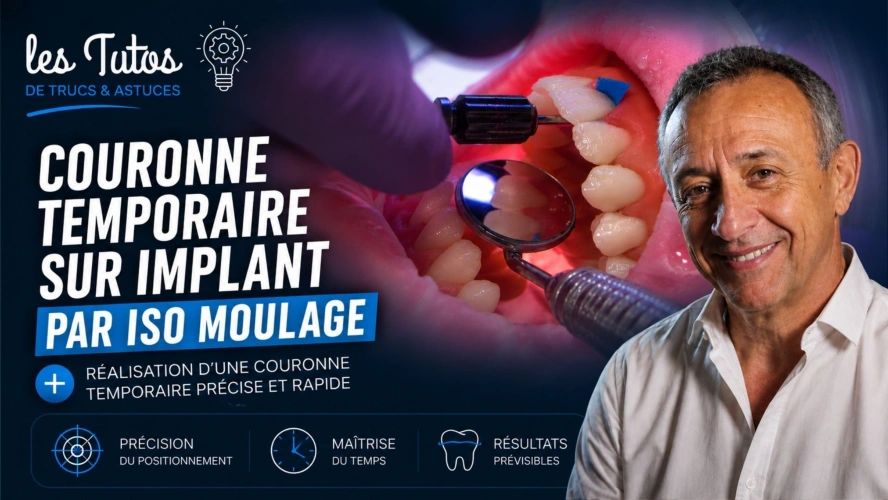 Couronne temporaire sur implant par iso moulage