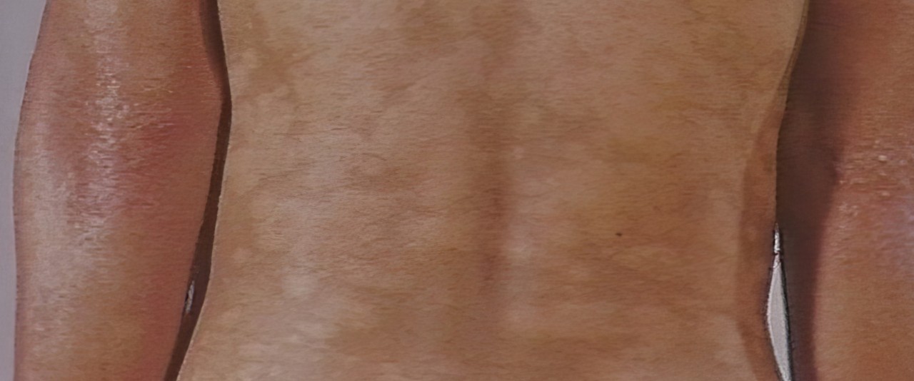 Combattre la lèpre (reo tahiti)