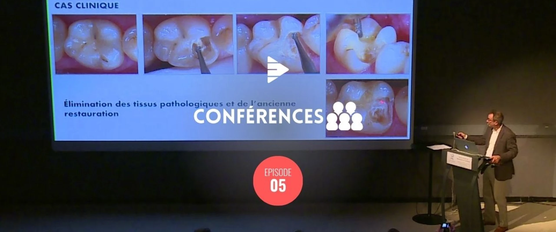 Inlays Onlays Partie 1