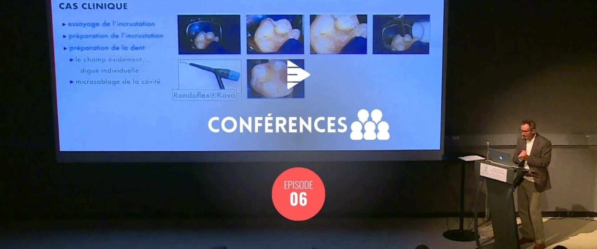 Inlays Onlays Partie 2